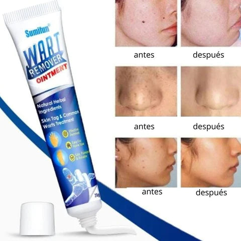 Wart Remover - Renovedor de verrugas