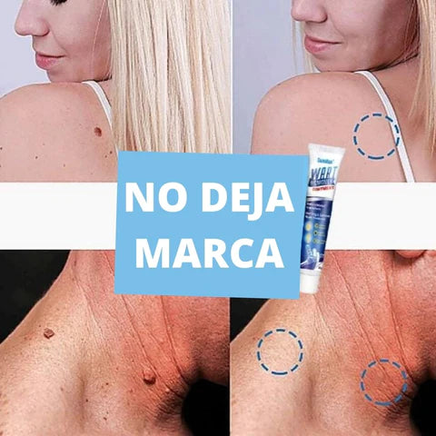 Wart Remover - Renovedor de verrugas